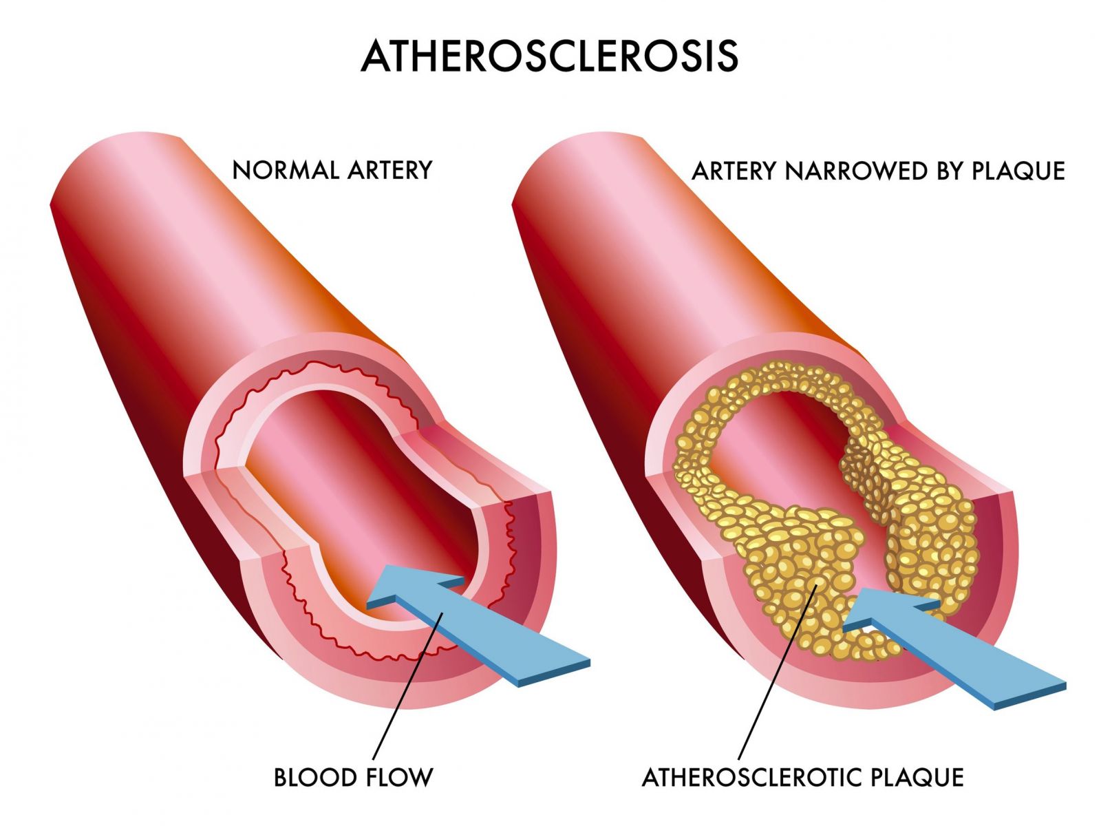 atherosclerosis-treatments
