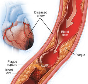 coronary-heart-treatments