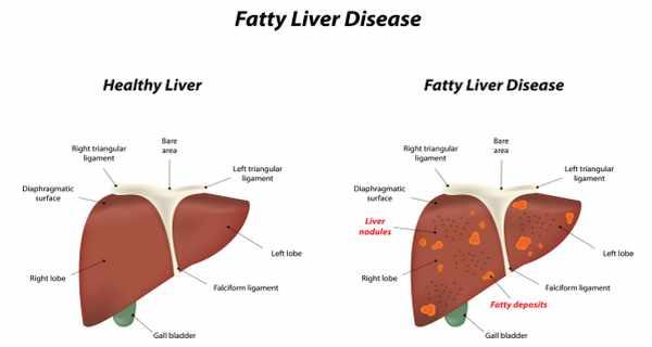 fatty-liver-treatments