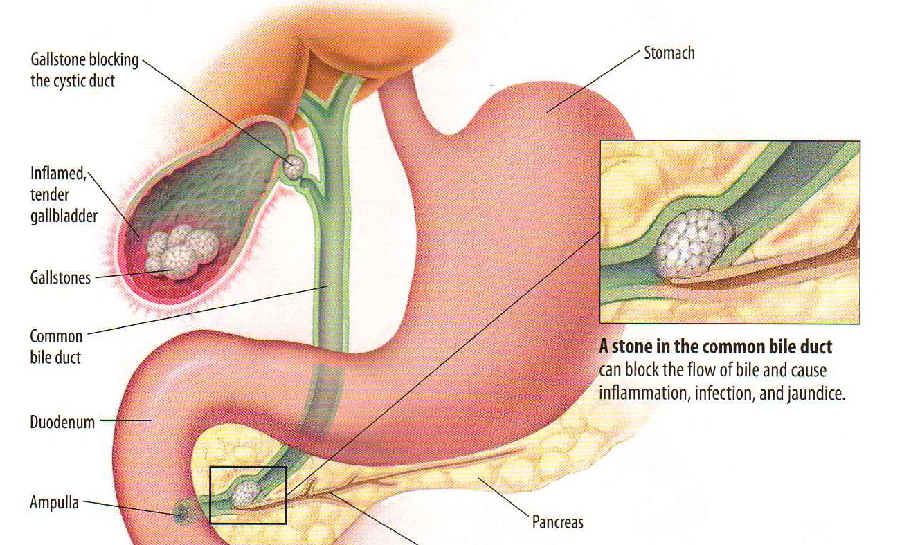 gall-stone-removal