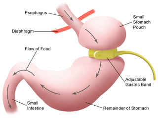 gastric surgery