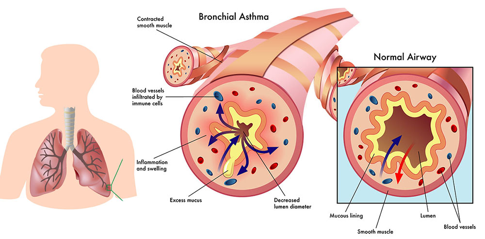 obesity-asthma-treatments