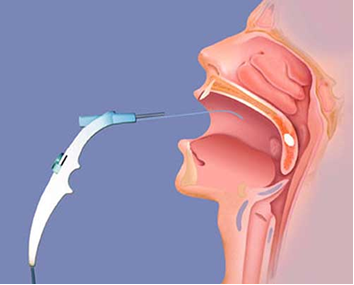 snoring surgery mumbai.png