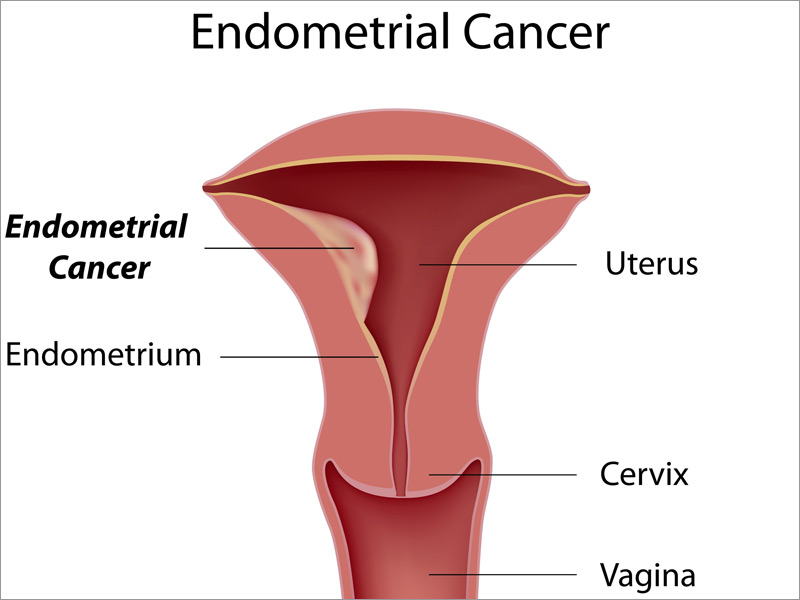 uterine-cancer-treatments